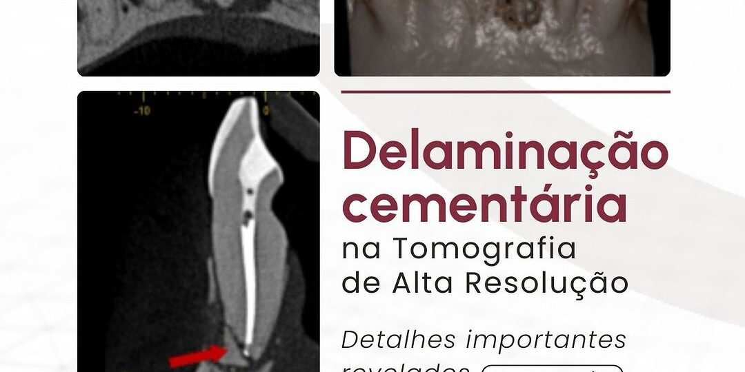 delaminacao-cementaria