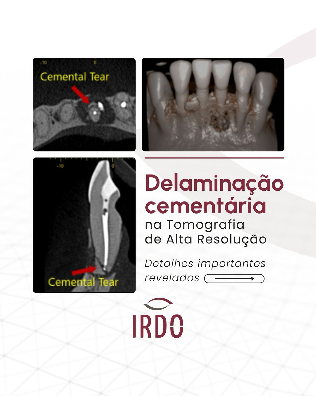 delaminacao-cementaria