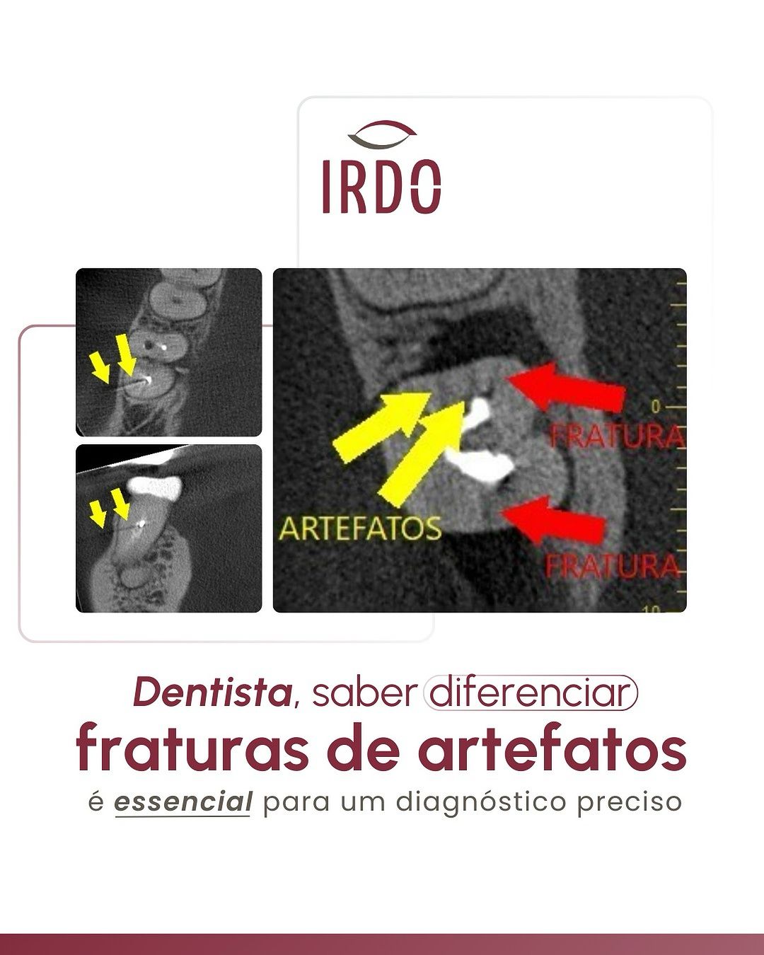diferenciacao-entre-fraturas-e-artefatos