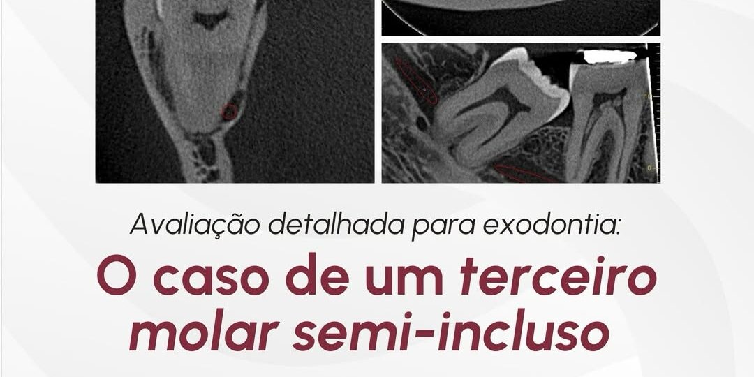 caso-de-um-terceiro-molar-semi-incluso