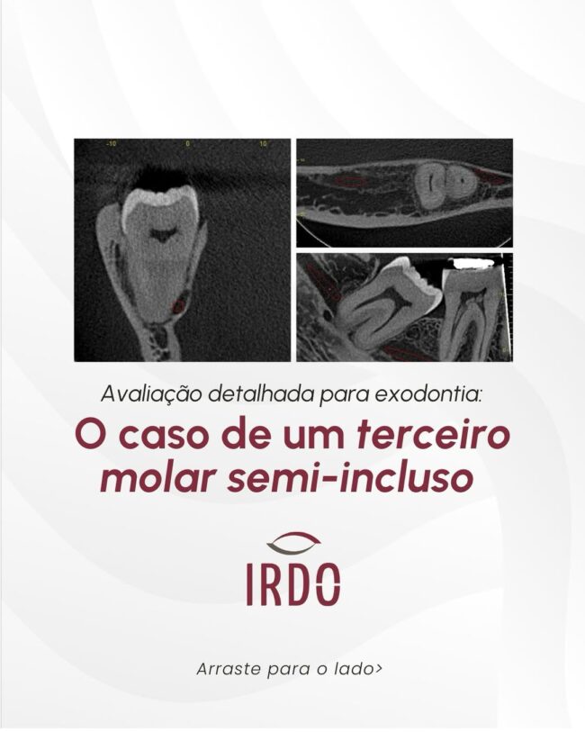 caso-de-um-terceiro-molar-semi-incluso