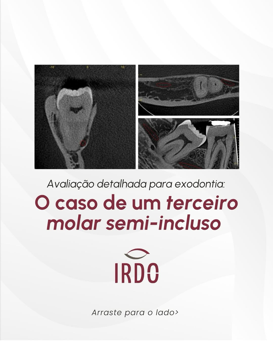 caso-de-um-terceiro-molar-semi-incluso