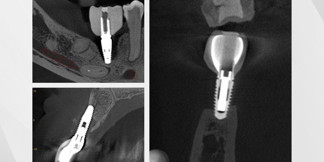 analise-tridimensional-de-perda-ossea