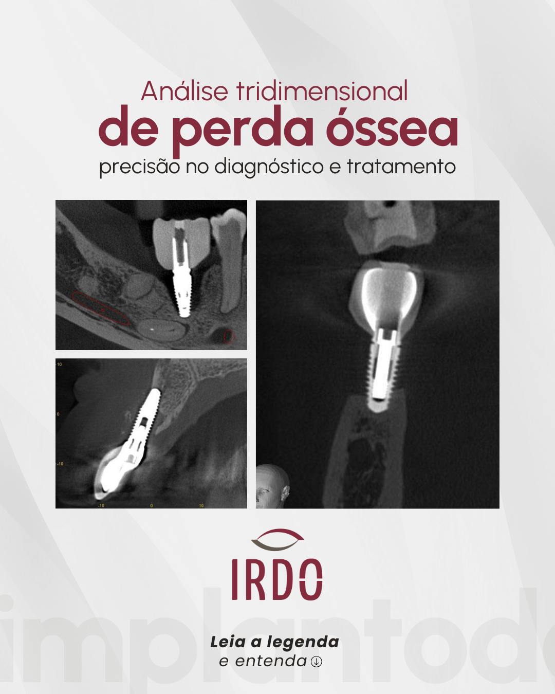 analise-tridimensional-de-perda-ossea