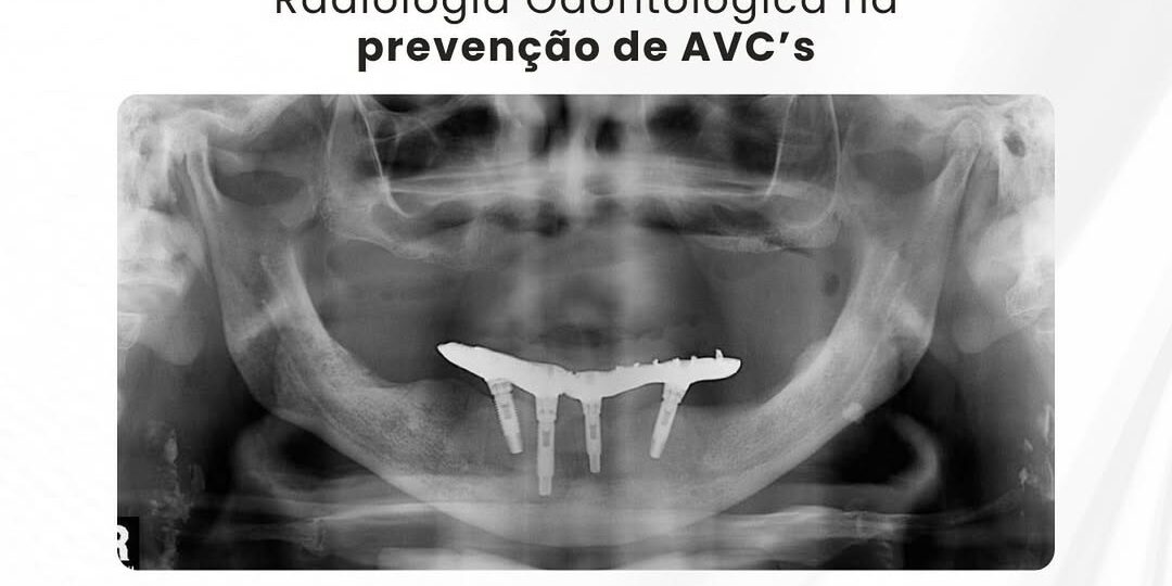 ateroma-da-arteria-carotida