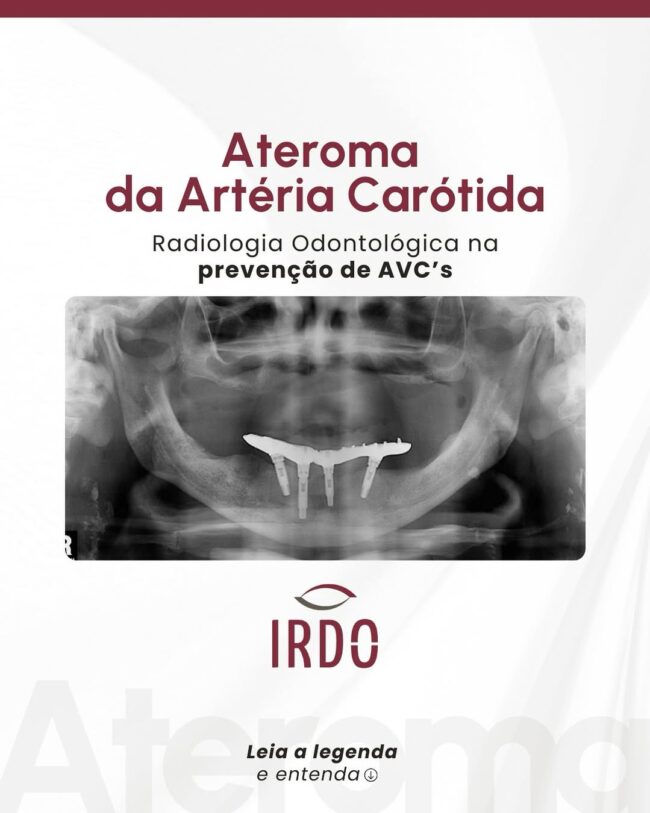 ateroma-da-arteria-carotida