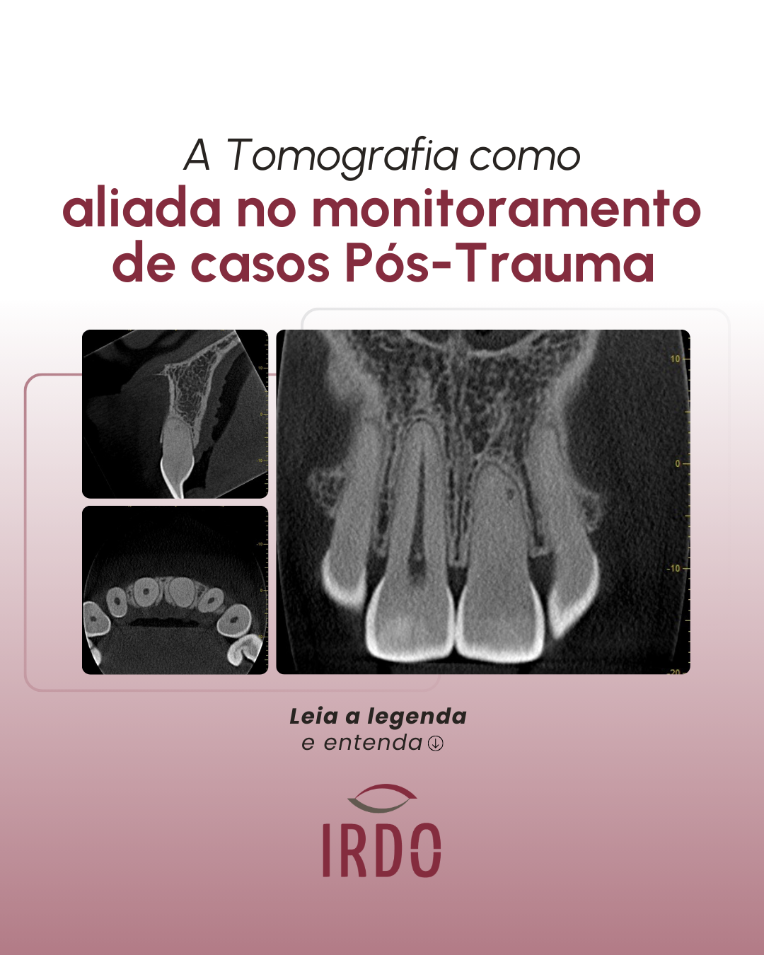 tomografia-como-aliada-em-casos-pos-trauma