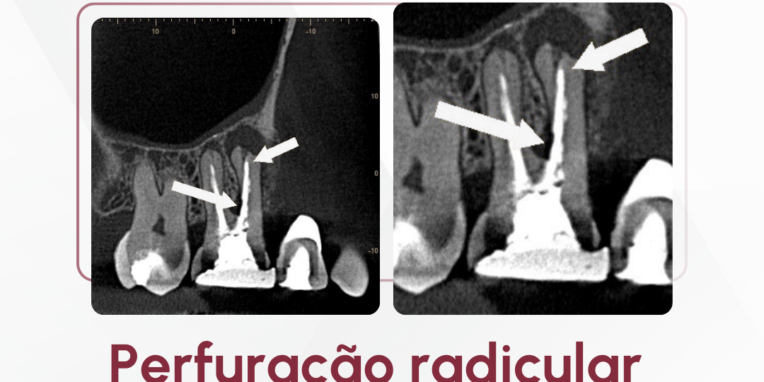 perfuracao-radicular-e-desvio-de-trajetoria