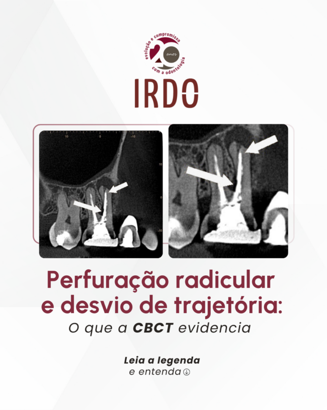 perfuracao-radicular-e-desvio-de-trajetoria