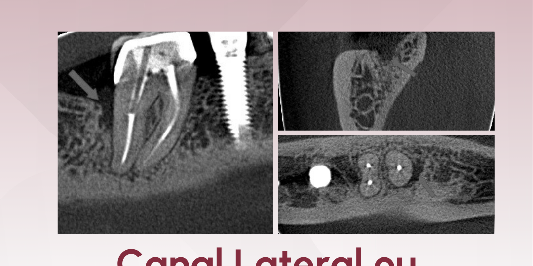 canal-lateral-ou-fratura-radicular