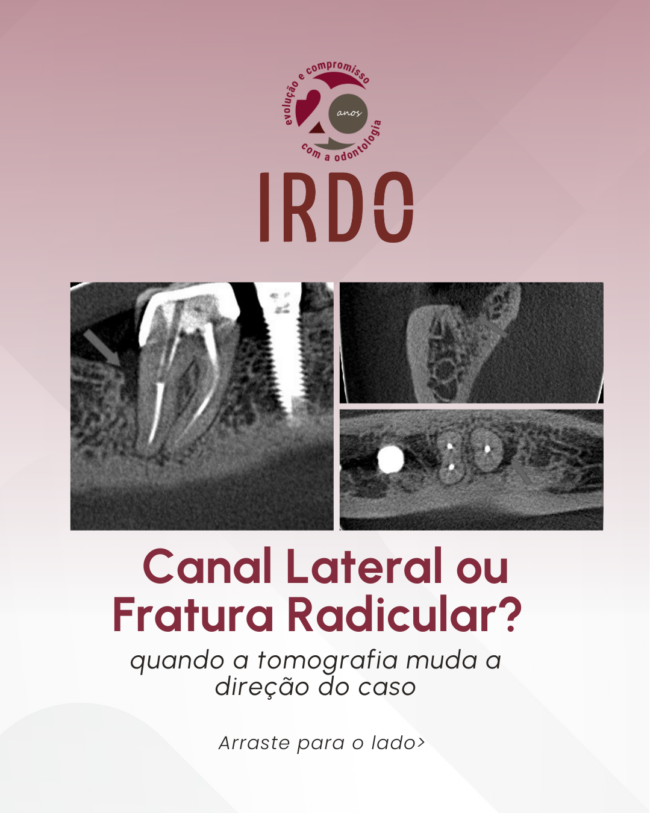 canal-lateral-ou-fratura-radicular