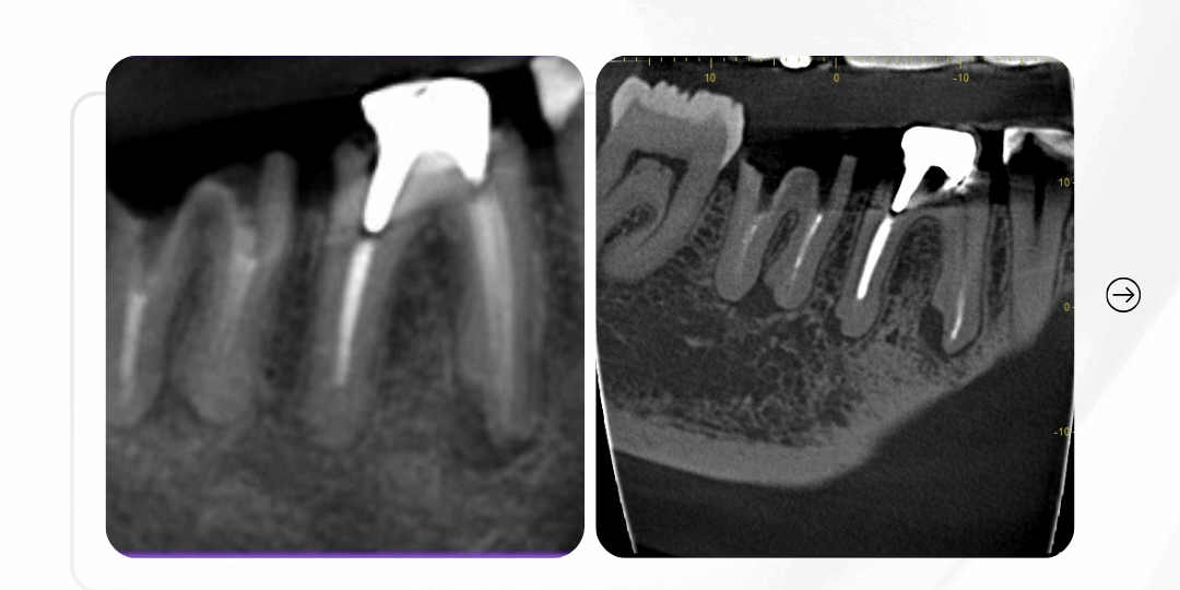 retratamento-endodontico