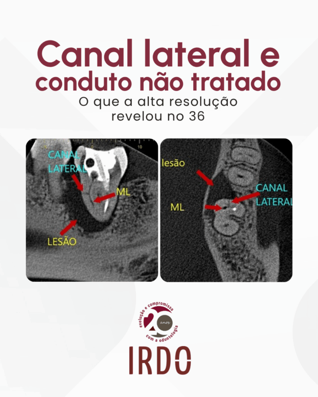 canal-lateral-com-lesao-associada