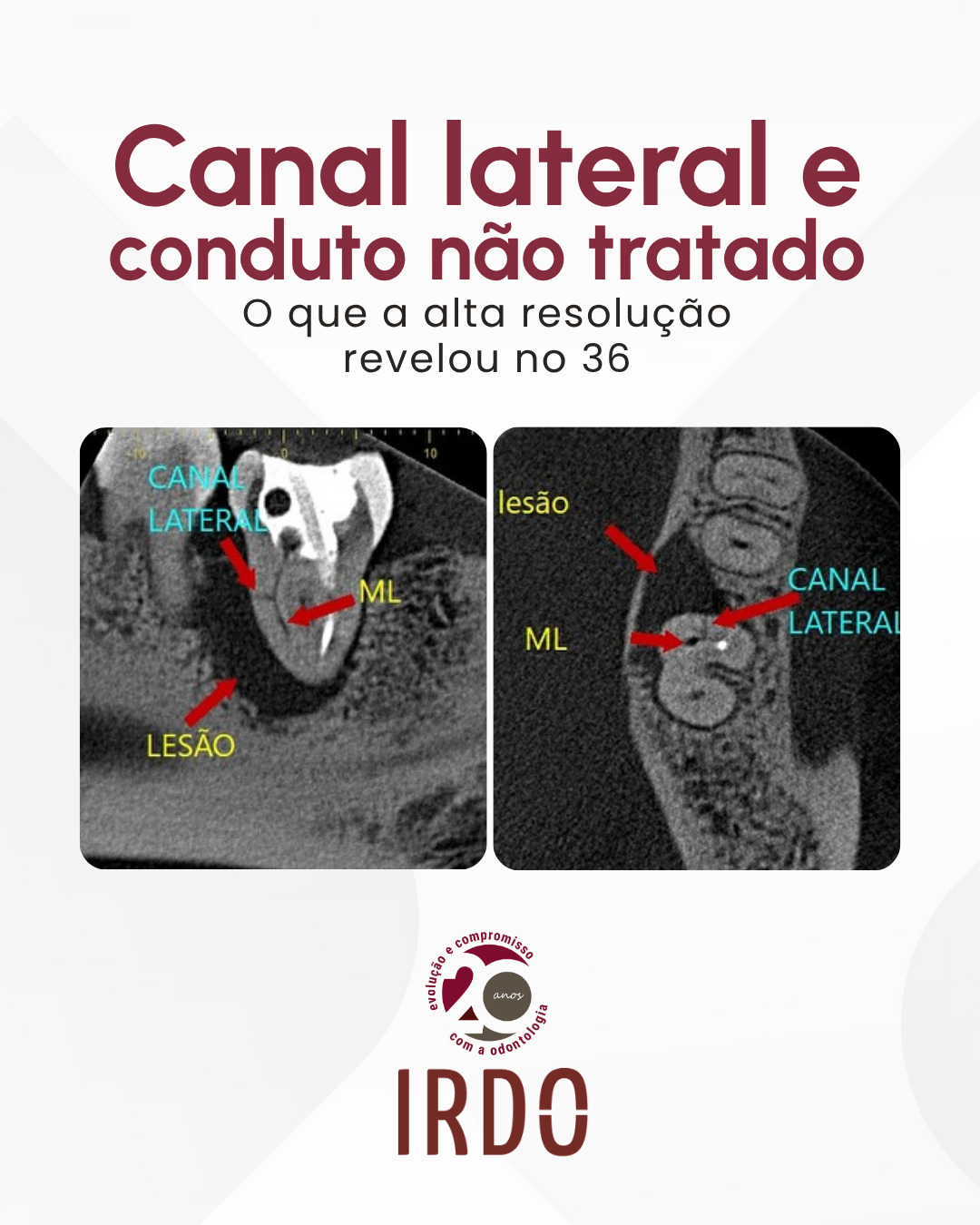 canal-lateral-com-lesao-associada