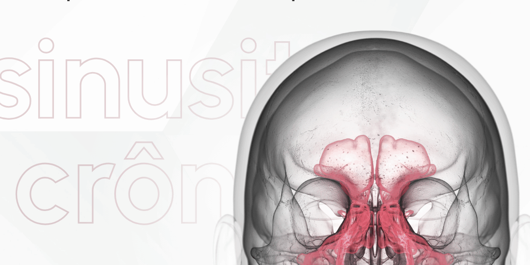 sinusite-cronica