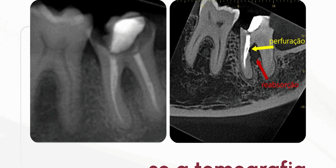 perfuracoes-radiculares