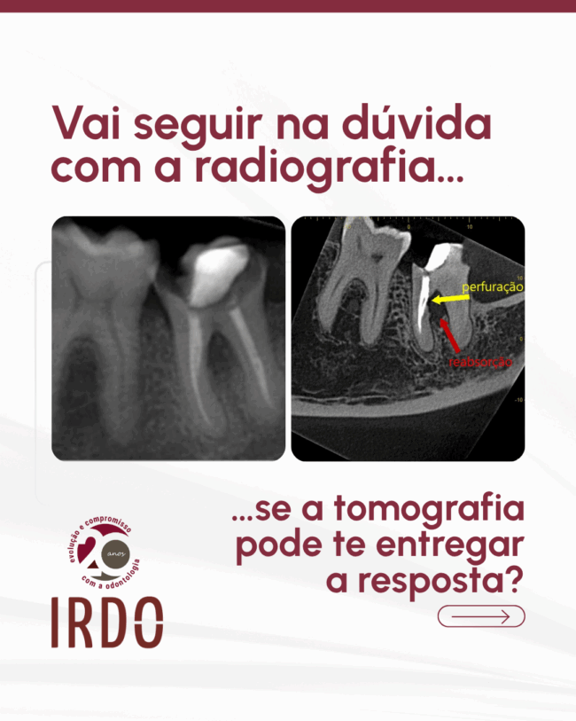 perfuracoes-radiculares