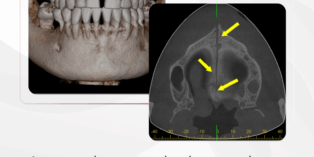 sutura-palatina-medial