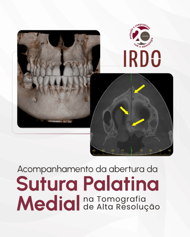 sutura-palatina-medial